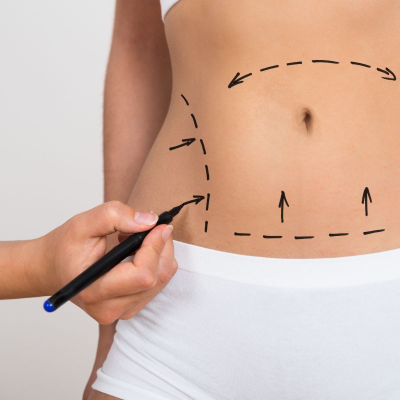 Abdominoplastia
