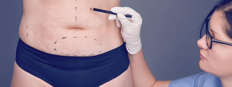 Dr. Gustavo Morellato explica como é a cirurgia pós-bariátrica