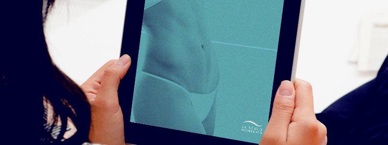 Lipoaspiração: tudo o que você precisa saber