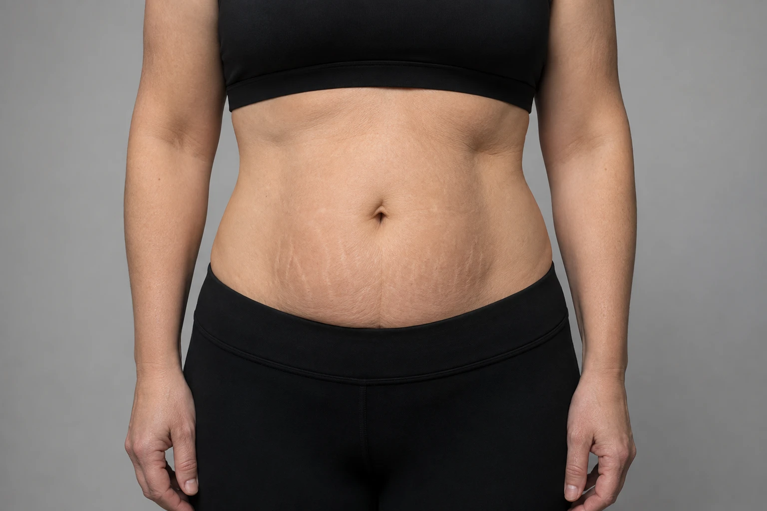Abdominoplastia pós-bariátrica: o que você precisa saber antes da cirurgia